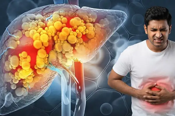 Fatty Liver Treatment